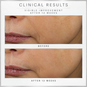 Before-and-after clinical results for Revision Skincare D.E.J Face Cream, comparison showing visible improvement after 12 weeks on a person's cheek and mouth area, with text reading 'CLINICAL RESULTS' and 'BEFORE' and 'AFTER 12 WEEKS'.