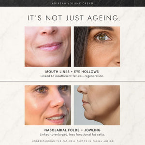 An informational skincare graphic for Adipeau Volume Cream. The top section features a close-up of a smiling mouth and cheek, labeled 'MOUTH LINES + EYE HOLLOWS'.