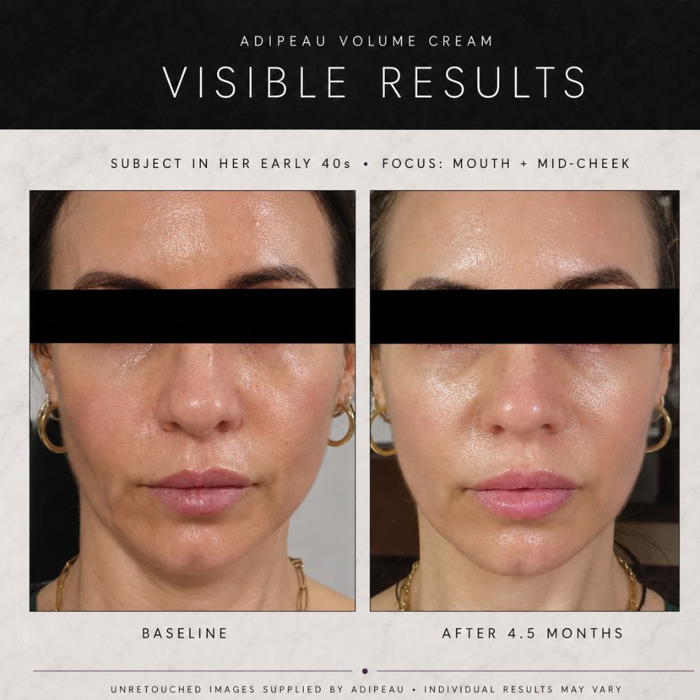 Before-and-after facial skin comparison for Adipeau Volume Cream, showing a woman's mid-cheek and mouth area with visible texture and hydration improvement over 4.5 months.