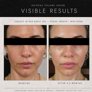 Before-and-after facial skin comparison for Adipeau Volume Cream, showing a woman's mid-cheek and mouth area with visible texture and hydration improvement over 4.5 months.