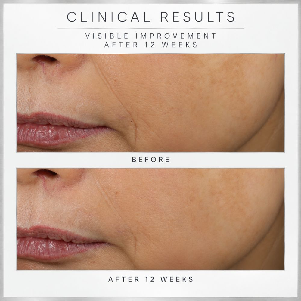 Before-and-after clinical results  for Revision Skincare D.E.J Face Cream, comparison showing visible improvement after 12 weeks on a person's cheek and mouth area, with text reading 'CLINICAL RESULTS' and 'BEFORE' and 'AFTER 12 WEEKS'.