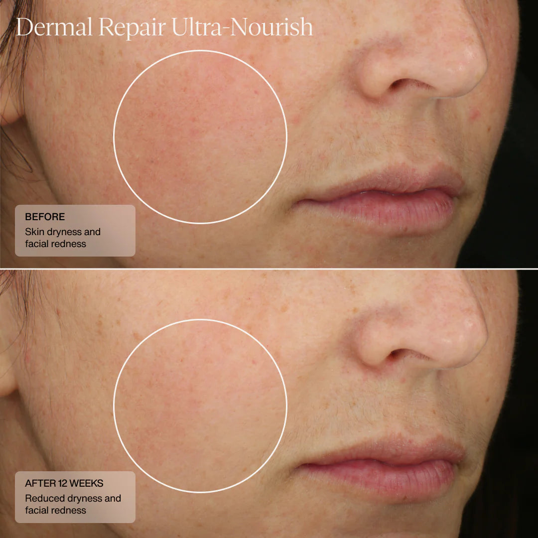 Before and after comparison of skin dryness and facial redness with Dermal Repair Ultra Nourish product.