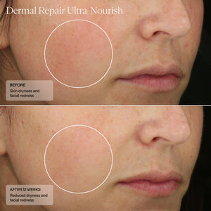 Before and after comparison of skin dryness and facial redness with Dermal Repair Ultra Nourish product.